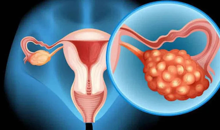 ovarian-cancer_V_jpg--816x480-4g
